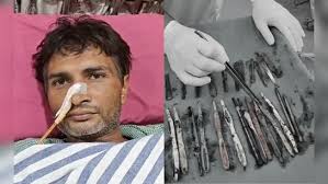 29 steel spoons, 19 tooth brushes removed from UP man’s stomach